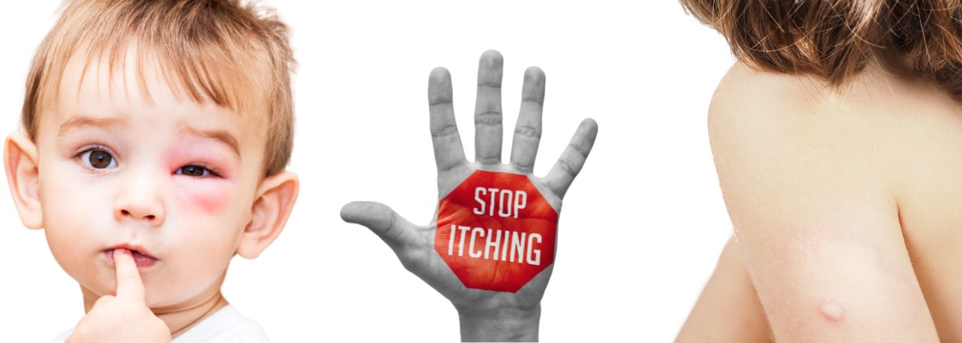 Hvepsestik under &oslash;jet p&aring; dreng samt hvepsestik p&aring; kvindes arm